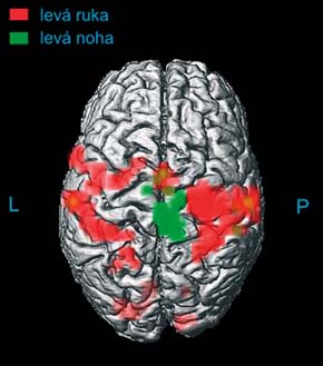 3D (trojrozměrné) zobrazení povrchu mozku vymodelované z ultratenkých skenů magnetickou rezonancí (MR). 3D modely nesoucí anatomickou informaci jsou fúzovány s funkčními mapami. Získáme tak představu o lokalizaci testovaných funkčních oblastí. Vyšetření na obr. ukazuje oblasti mozkové kůry aktivované při pohybu levé nohy a ruky. Orig. P. Bednařík