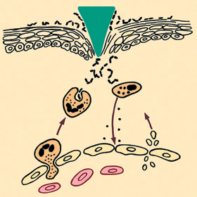 Schéma zánětu. Do místa poranění kůže vnikají bakterie (a), žírné buňky uvolní histamin zvyšující propustnost cévní stěny (b), z kapilár vycestovávají krevní destičky, které zahajují srážení krve a uvolňují TGF-ß (transformační růstový faktor beta). TGF-ß aktivuje makrofágy, ale později zánět brzdí a napomáhá obnově poškozených tkání (c). Do místa zánětu vcestovávají granulocyty – neutrofily (d), které pohlcují bakterie (e). Všechny přítomné buňky rozpoznávají struktury bakterií pomocí receptorů TLR, produkují zánětové cytokiny a ty zesílí uvedenémechanismy. Blíže v textu. 
<br/>Orig. I. Trebichavský
