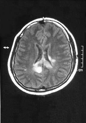 Snímek mozku pacienta s projevy demyelinizačního při roztroušené skleróze mozkomíšní. Vyšetření provedla Klinika zobrazovacích metod 2. LF UK a FN Motol. Foto z archivu M. Bojara