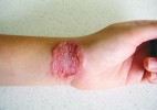 Kruhovitá léze na zápěstí způsobená rodem Trichophyton ze skupiny  dermatofyt (tinea corporis). Nákaza vznikla přenosem ze zvířete. Foto N. Mallátová