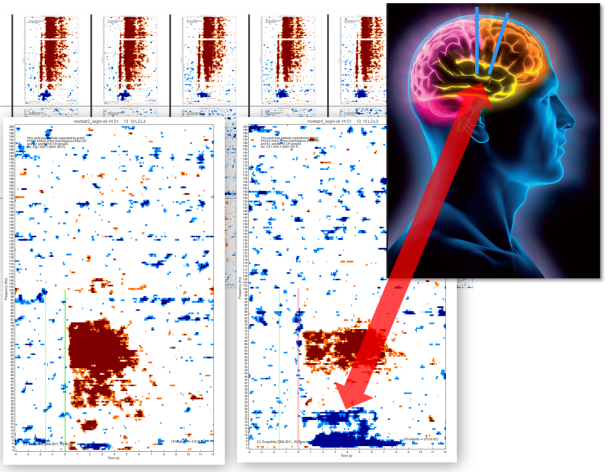 Deep brain activity research 