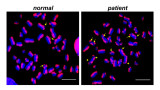 Sister chromatid exchange (yellow arrows) in cells from a healthy control (left) and a patient with defects in the single-strand break repair pathway (right). Scale bars, 10 micrometres.