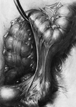 Kresba přírodním uhlem Maxe Brödela zachycuje chirurgický zákrok při adhezi střev. Archiv M. Chumchalové / © Archive M. Chumchalová