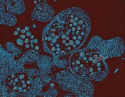 T-lymfocyty infikované HIV. Nové viriony se uvolňují do zevního prostředí pučením z buněčné membrány. Prozařovací elektronový mikroskop, počítačově obarveno. Foto F. Weyda