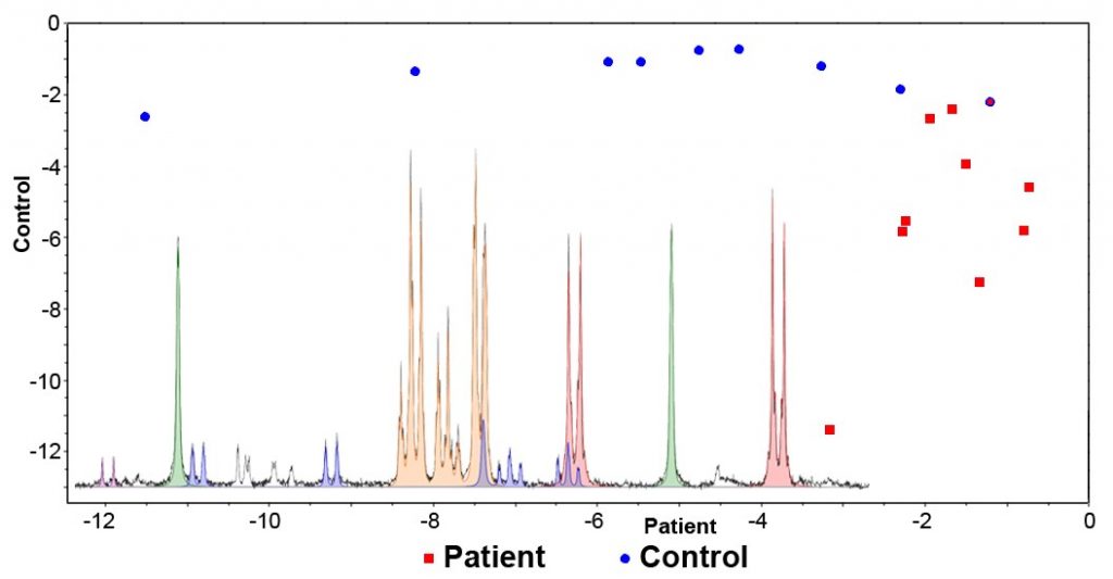 Diagnóza rakoviny slinivky pomocí 1H NMR metabolomické analýzy krevní plazmy