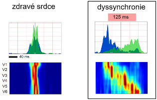 Patentovaná technologie dokáže jasně rozlišit typ patologie a  změřit dyssynchronii srdečních komor s přesností na milisekundy