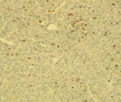 Histologické vyšetření nádorů vyvolaných u myší buňkami transformovanými lidským papillomavirem. Řez nádorem neléčeného zvířete (velikost nádoru 7x6x2). Foto Š. Němečková a J. Jelínek / © Š. Němečková a J. Jelínek