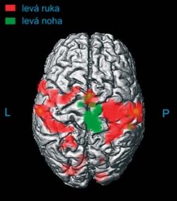 3D (trojrozměrné) zobrazení povrchu mozku vymodelované z ultratenkých skenů magnetickou rezonancí (MR). 3D modely nesoucí anatomickou informaci jsou fúzovány s funkčními mapami. Získáme tak představu o lokalizaci testovaných funkčních oblastí. Vyšetření na obr. ukazuje oblasti mozkové kůry aktivované při pohybu levé nohy a ruky. Orig. P. Bednařík / © P. Bednařík